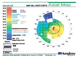 This map from 2004 indicates more symmetry and sphericity on both sides of the cornea