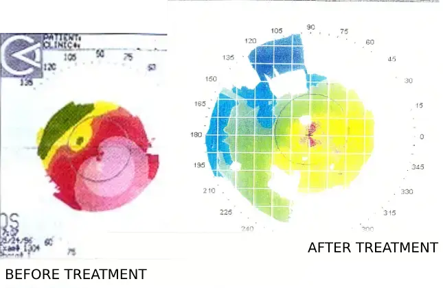 Before and after treatment scans of left eye (OS).